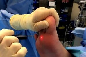 Métodos cirúrgicos de remoção de verrugas