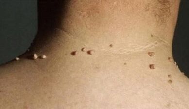 As razões para o aparecimento de papilomas no corpo humano