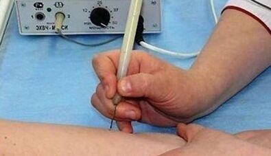 Como se livrar dos papilomas no corpo