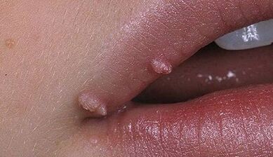 Tipos de papiloma em humanos