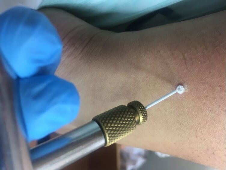 maneiras de remover verrugas