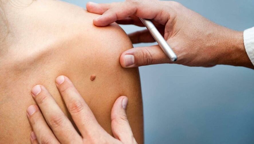 Dermatologista examinando um paciente com papiloma