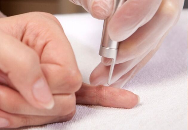 remoção de verrugas no dedo