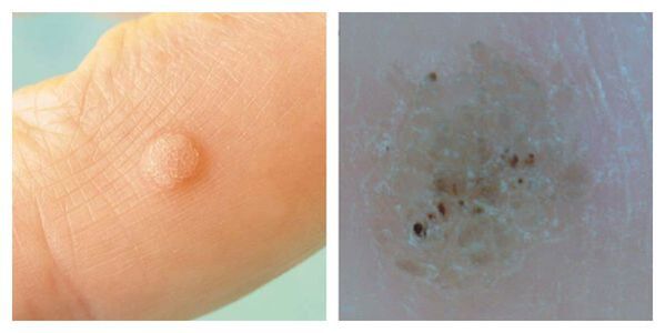 Verruga comum durante o exame e dermatoscopia