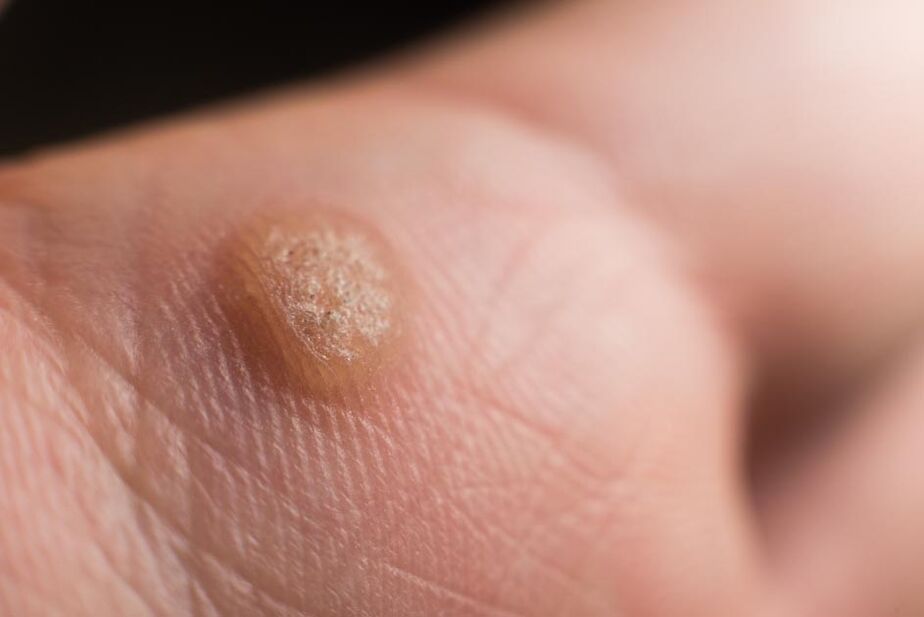 papilomavírus humano na pele