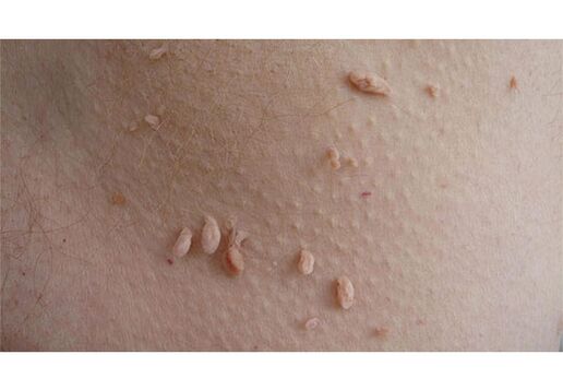 Um sinal de infecção por HPV é o aparecimento de papilomas no corpo