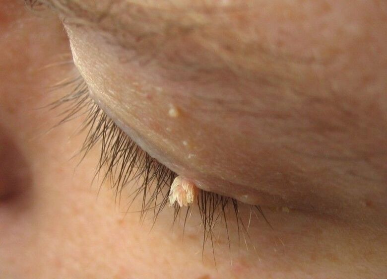 Verrugas na frente de nossos olhos