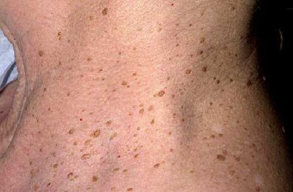verrugas senis